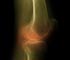 knie_roentgenbild